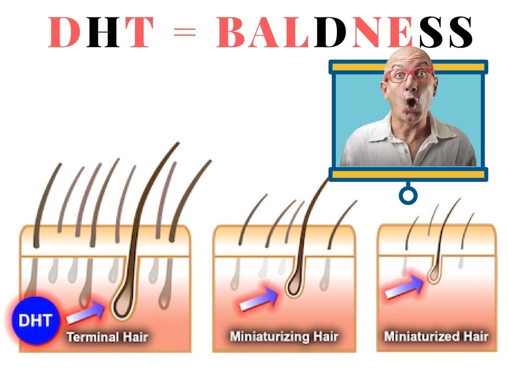 DHT Contribute to Balding