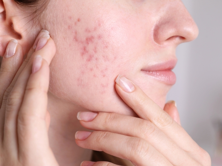 Advanced Acne Scar Healing